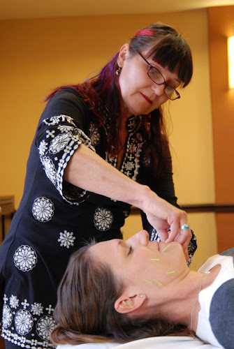 Denver Cosmetic Acupuncture