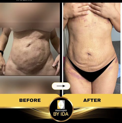 Lymphatic Massage By Ida Miami Fl