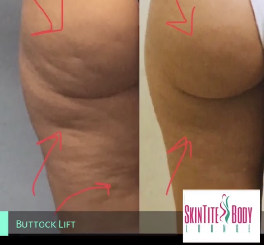 SkinTite Body Spa-Houston